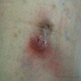 Кожный стафилокок: симптомы и лечение Кожный стафилокок: симптомы и лечение