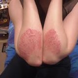 Псориаз: симптомы и лечение