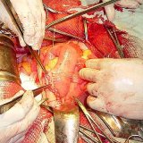 Хирургия перитонита, абдоминальный сепсис