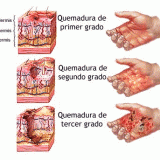 Какие бывают виды ожогов