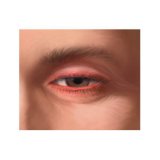 Заболевание глаз - блефарит