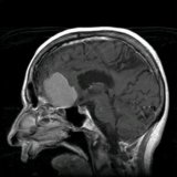 Методы лечения опухоли головного мозга