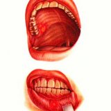 Особенности течения гнойно воспалительных заболеваний полости рта