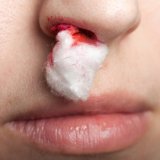 Причины носовых кровотечений