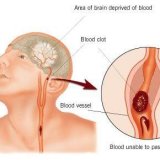Симптомы нарушения мозгового кровообращения