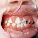 Гингивит: заболевания полости рта у детей