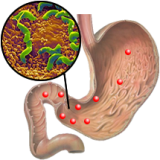  Helicobacter Pylori