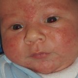 Острые инфекционные и аллергические заболевания у детей