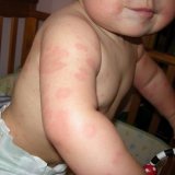 Профилактика аллергии у детей