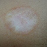 Ятрогенная рубцово-пигментная атрофия кожи, лечение