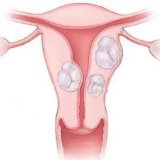 Лечение фибромиомы матки народными средствами