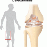 Лечение и профилактика остеоартроза