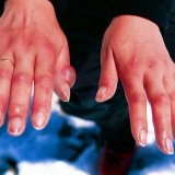 Обморожение пальцев, симптомы и лечение