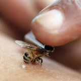 Лечение укусами пчел