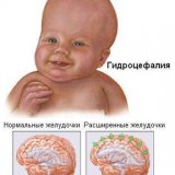 Водянка головного мозга у новорожденного