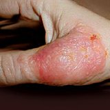 Аллергический дерматит: симптомы
