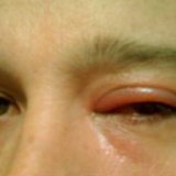 Глазной клещ: лечение