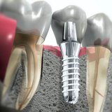 Имплантация зубов: за и против
