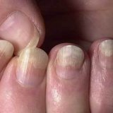Народные средства лечения псориаза ногтей