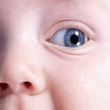 Отёки глаз у новорожденных