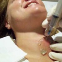Малоинвазивная хирургия щитовидной железы