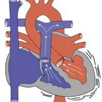 Стеноз легочной артерии