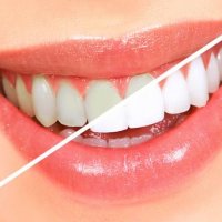 Безопасное отбеливание зубов в домашних условиях