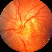 Лечение атрофии зрительного нерва
