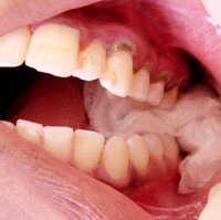Как остановить кровотечение после удаления зуба?