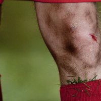 Виды травм коленного сустава