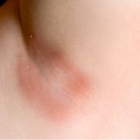 Аллергия в подмышечной области