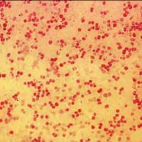 Менингококковая инфекция: симптомы и лечение
