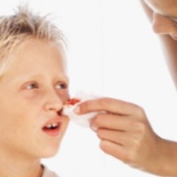 Носовые кровотечение у детей