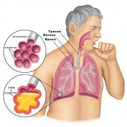 Стрептококковая пневмония