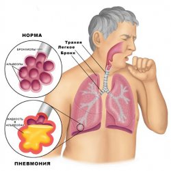 Хроническая пневмония: симптомы, клиническая картина, лечение