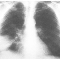 Кандидозная пневмония, или инвазивный кандидоз лёгких