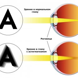 Виды нарушения зрения