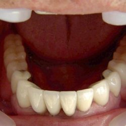 Виды материала, применяемые при несъемном протезировании зубов
