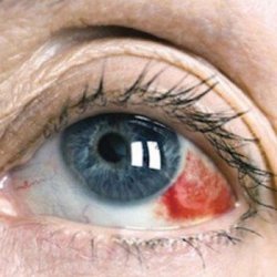 Лечение при кровоизлиянии в глаза