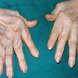 Что такое ревматоидный артрит