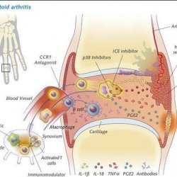 Характеристика ревматоидного артрита