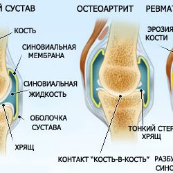 Развитие ревматоидного артрита
