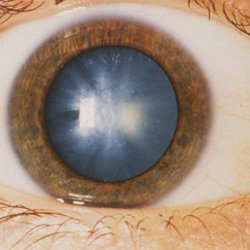Глазная катаракта