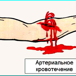 Артериальное кровотечение первая помощь