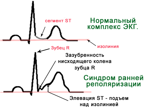 Деполяризация чем лечить