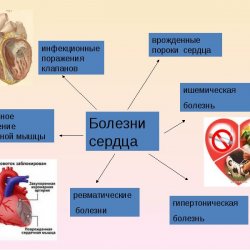 Классификация ишемической болезни сердца