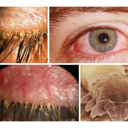 Причины демодекоза глаз