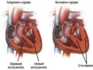 Описание гипертрофии сердца