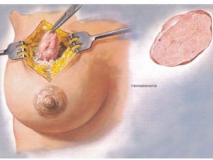 Удаление фиброаденомы груди