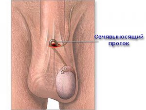 Причины возникновения деферентита